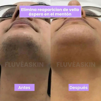 Lunéa™ - Vello fino y menos visible con Raiz de Cyperus Rotundus