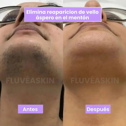 Lunéa™ - Vello fino y menos visible con Raiz de Cyperus Rotundus